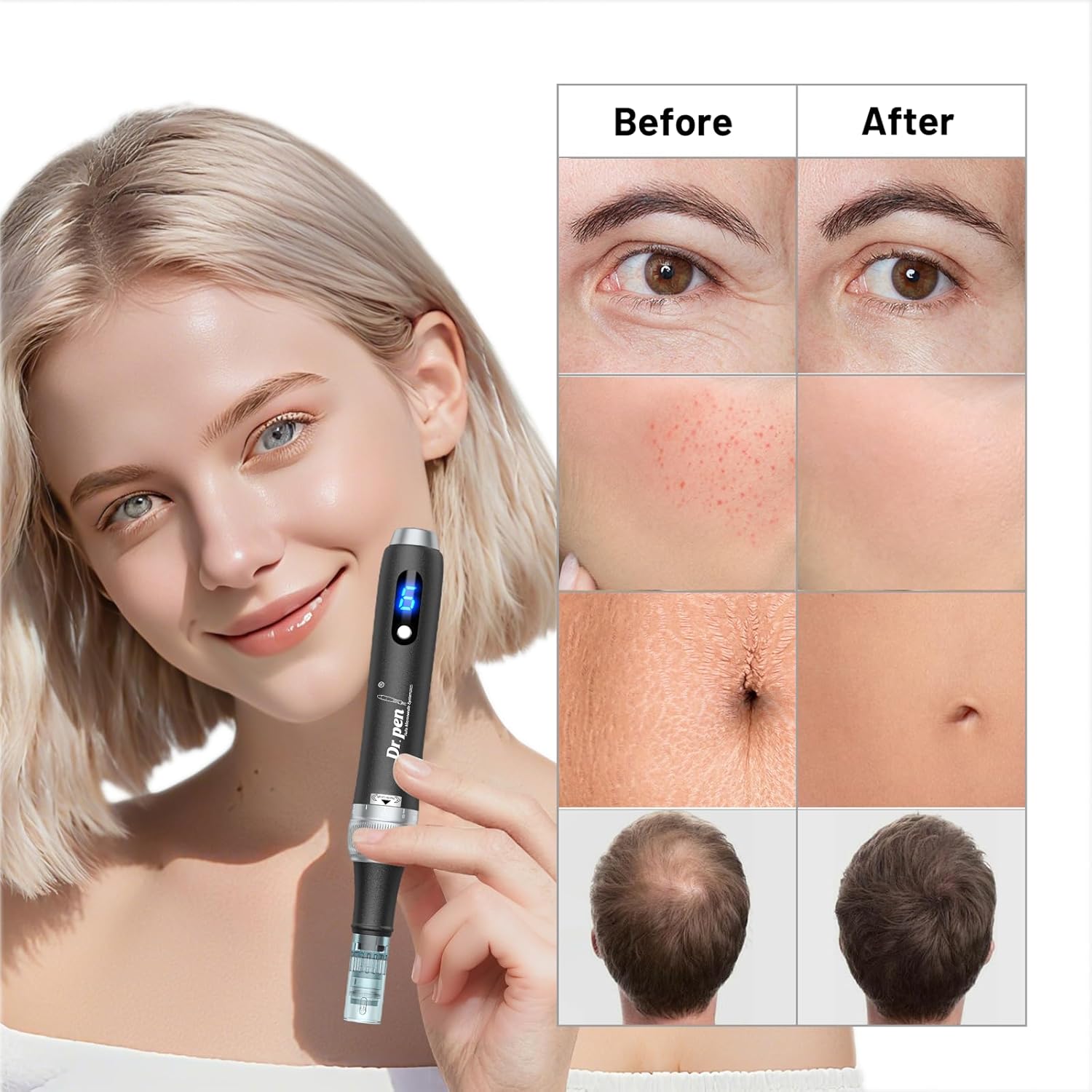 Thumbnail 2 de Buyounger M7S Dermapen microneedling wireless con 25 cartucce, 6 livelli e display LED