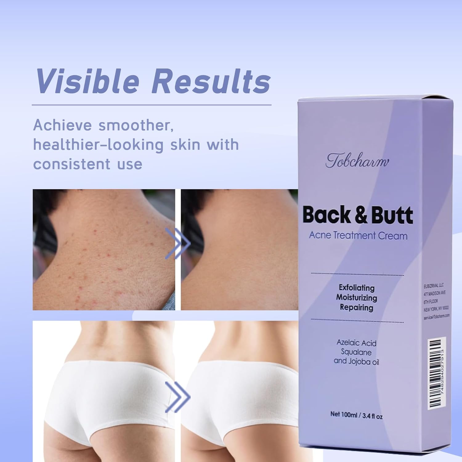 Detalle de Butt Acne Clearing Treatment – Maximum Strength Körpercreme gegen Bacne, Po-, Rücken- und Brustakne (Men & Women)
