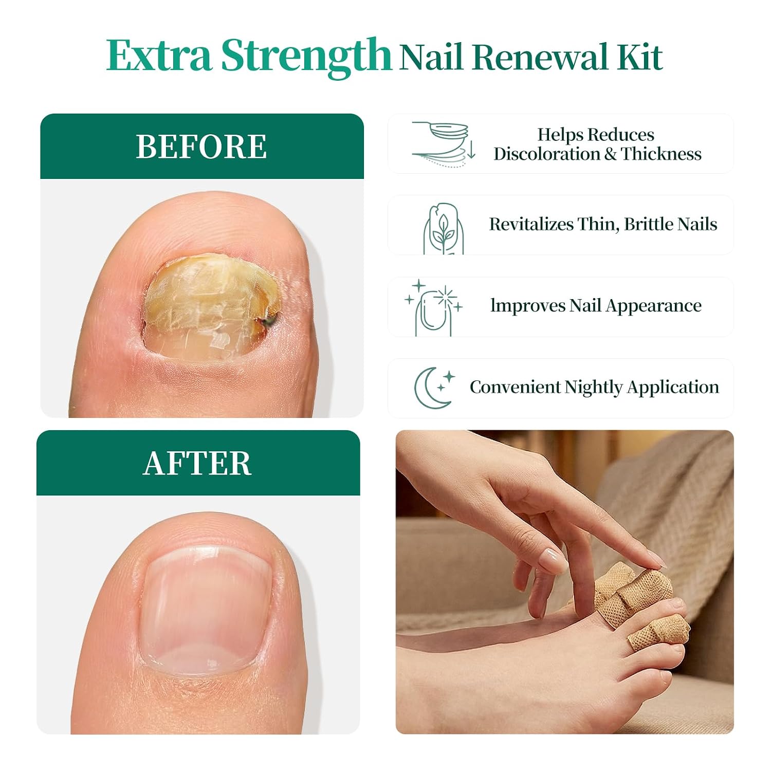 Detalle de APUREE Fungal Nail Patches Extra Strength with Tolnaftate 1% (32 Patch) for Overnight Toe Nail Treatment
