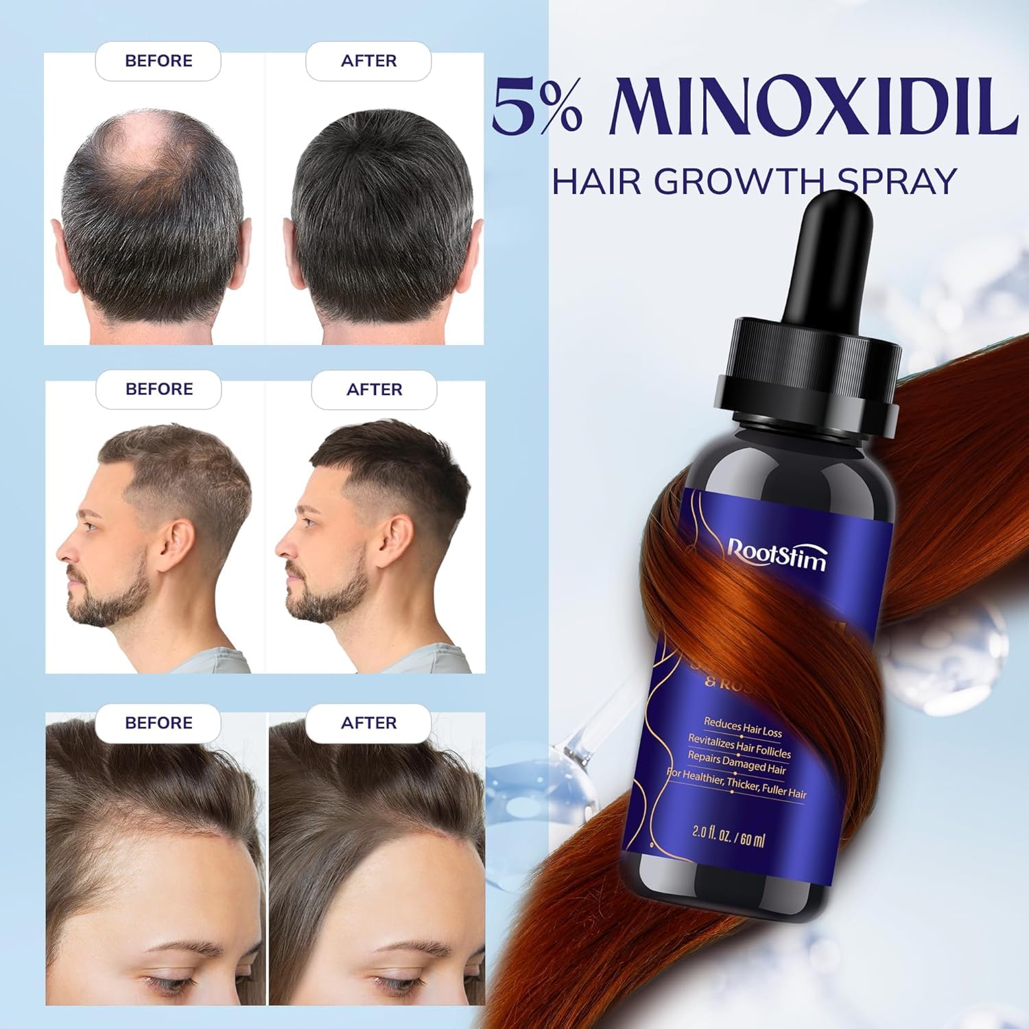 Thumbnail 5 de Minoxidil Hair Growth Treatment 4.04 fl oz