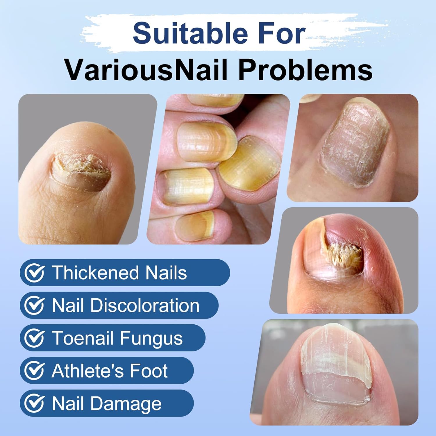 Detalle de Toenail Fungus Treatment Extra Strength: Fungi Nail Pen, 25% Undecylenic Acid, 6-Piece Kit