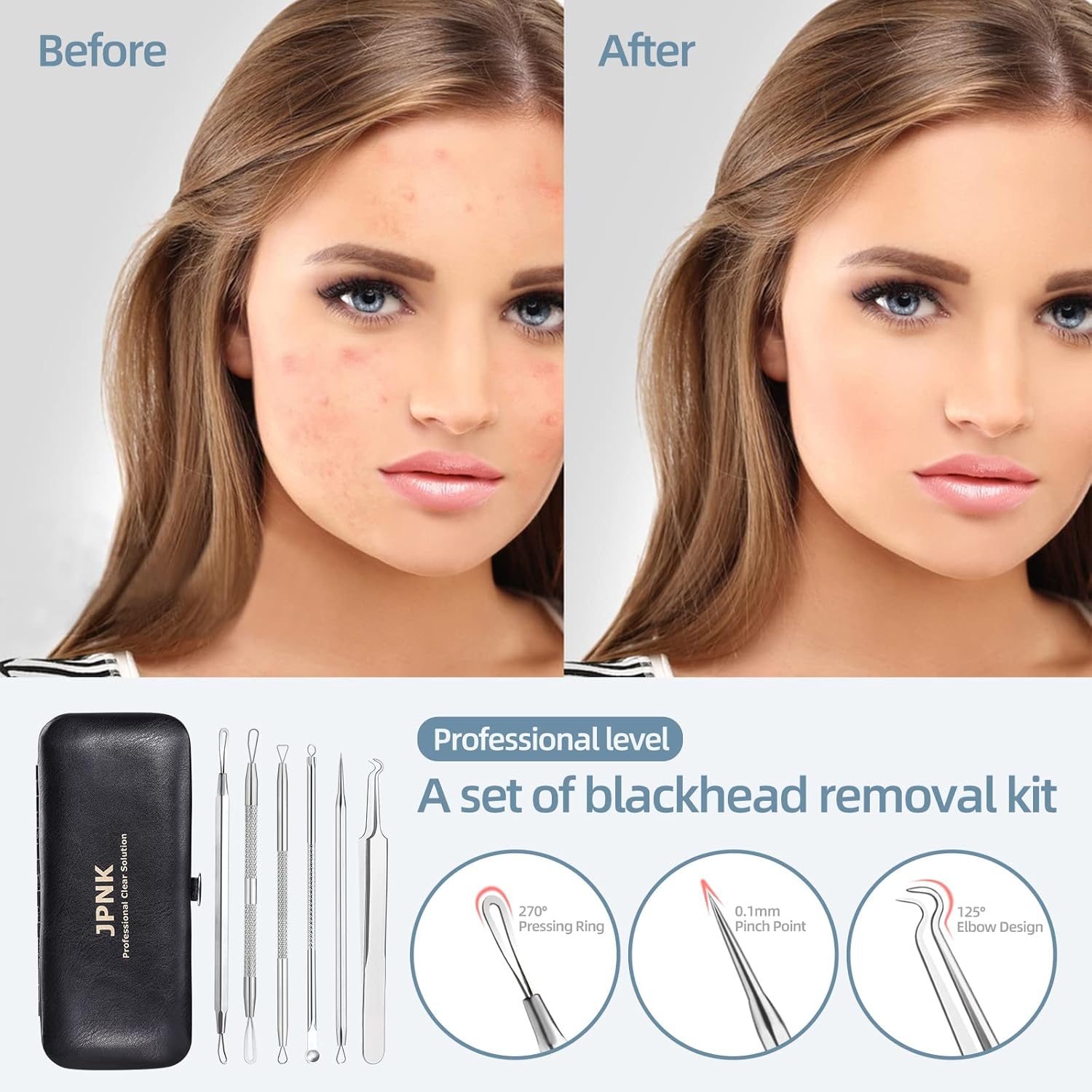 Thumbnail 1 de JPNK Blackhead Remover kit for acne extraction