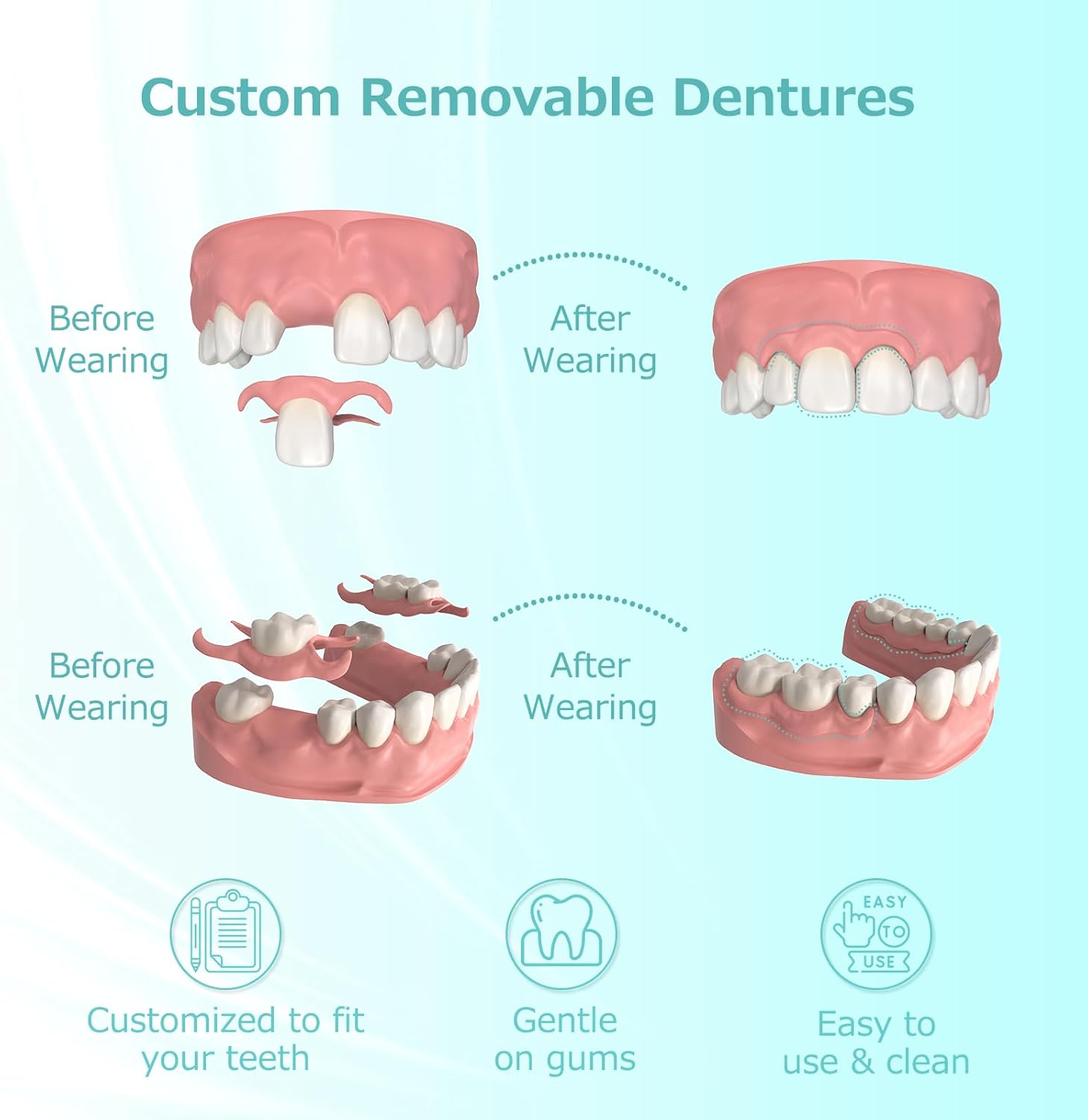 Thumbnail 3 de Partial denture kit for 1 missing tooth