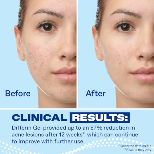 Detalle de Differin Acne Retinoid Treatment Gel 0.1% Adapalene, 45g Pump – FDA-Approved OTC Retinoid