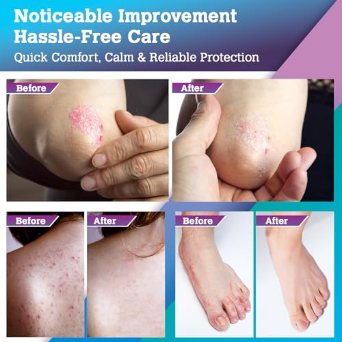 Detalle 2 de Kopa Haiku Antifungal Cream for Scalp & Body Skin (20g) – Suitable for Athletes Foot, Ringworm, Jock Itch, Tinea Versicolor & Seborrhoeic Dermatitis