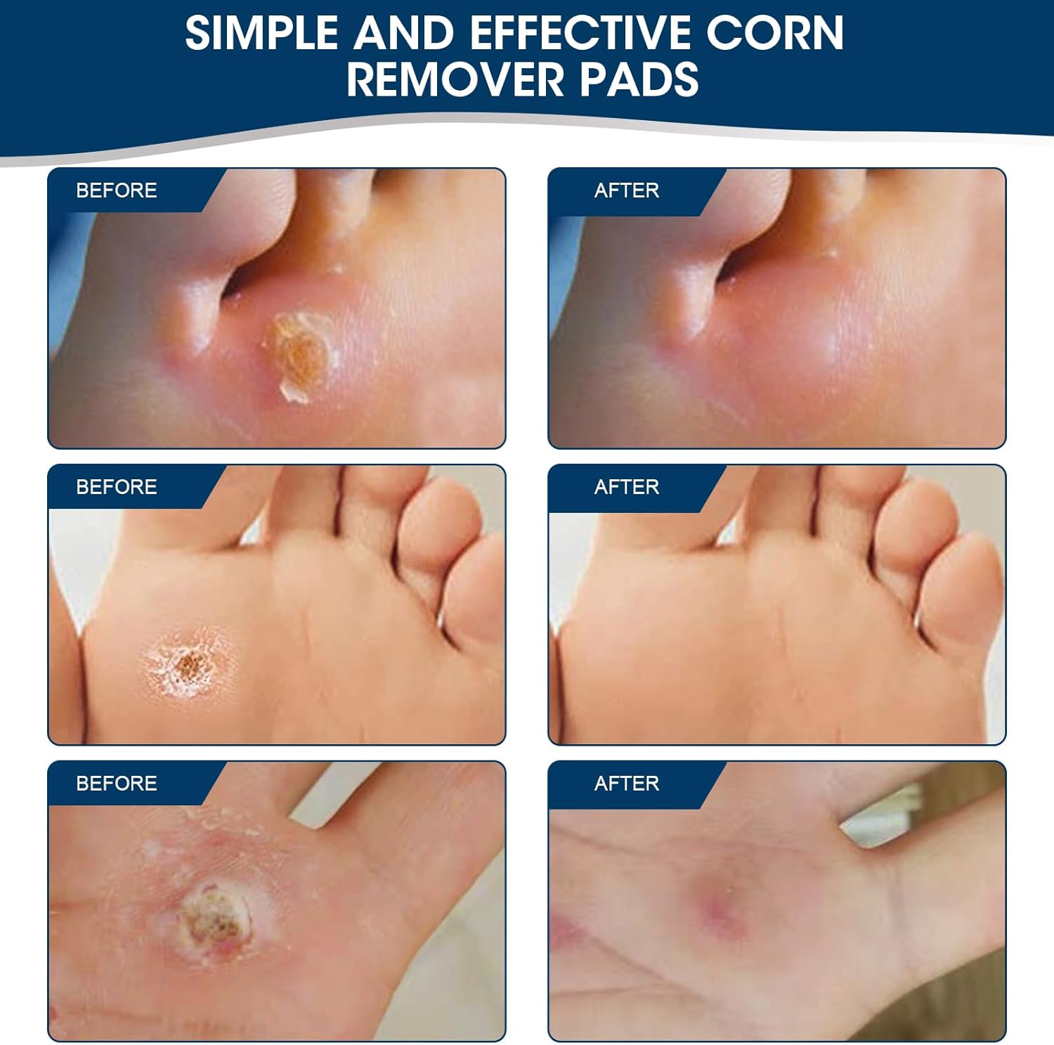Thumbnail 5 de MYMULIKE Corn Removal Plasters for Feet – 60 Count Corn Cushions for Feet, Toes, Hands and Wart Removal