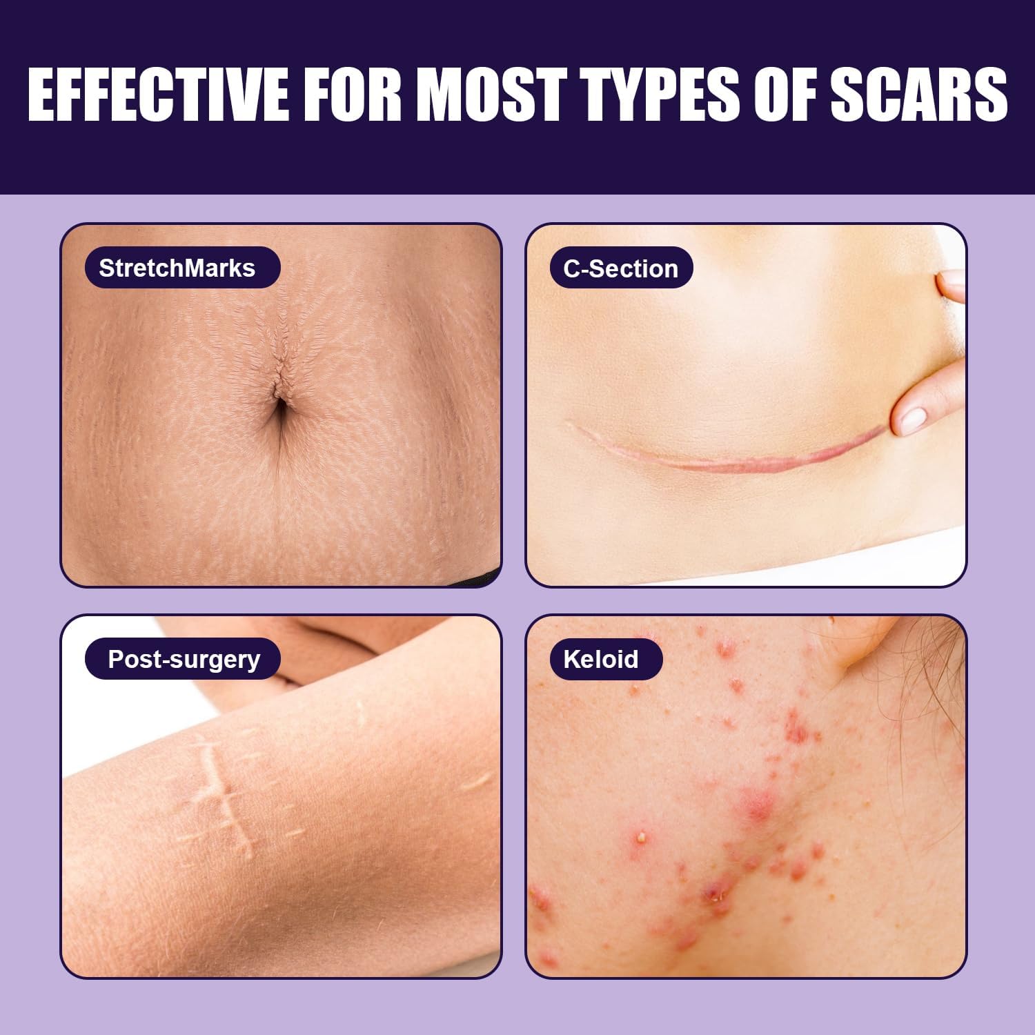Thumbnail 3 de Silicone Scar Tape 4cm x 1.5M — Ultra‑Thin, Reusable Silicone Scar Sheets for Keloids, C‑Sections, Acne and More