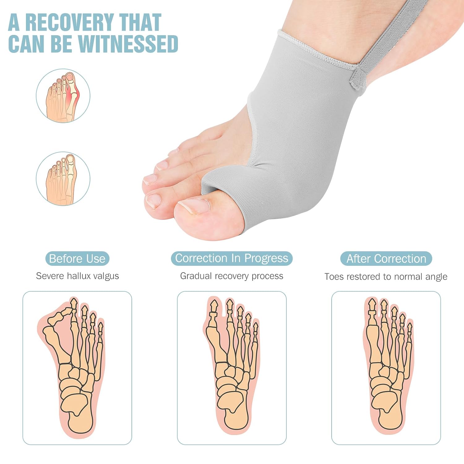 Thumbnail 4 de sundpik Bunion Corrector, 2-Piece Adjustable Toe Splint with Toe Spacer