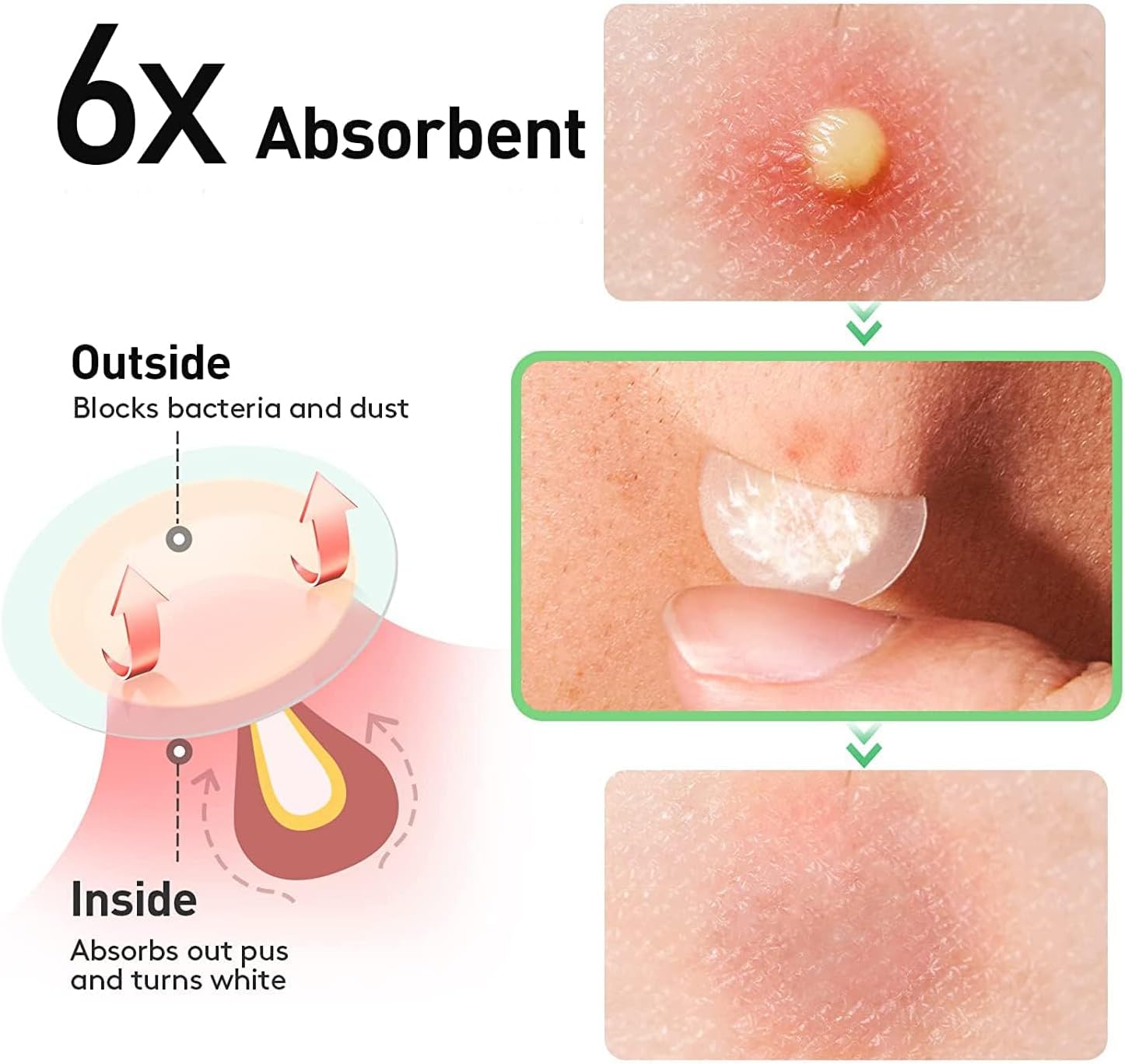 Detalle de Patch bouton hydrocolloïde 2-en-1 300 pièces (imperméable, invisible) pour acné jour et nuit