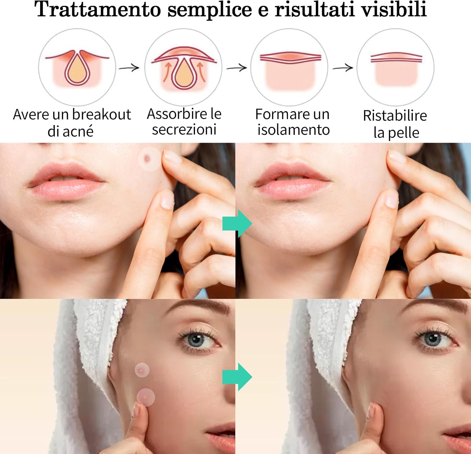 Thumbnail 3 de Home Holic Patch Brufoli in Idrogel 2-in-1 Giorno e Notte, cerotti invisibili e traspiranti per acne (528 pz)