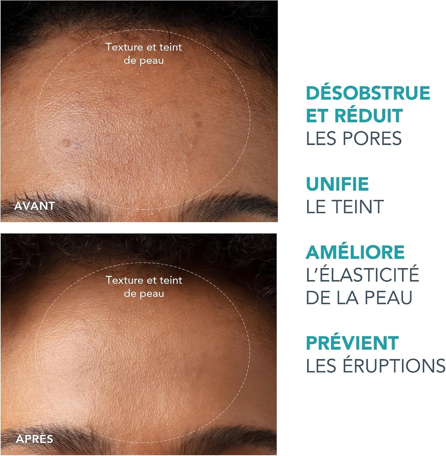 Detalle de FOREO KIWI Extracteur De Points Noirs – Aspirateur De Pores Avec Lumière