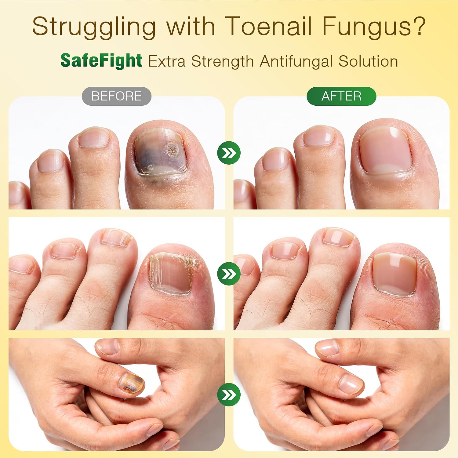 Detalle de SafeFight Toenail Fungus Treatment 30 mL