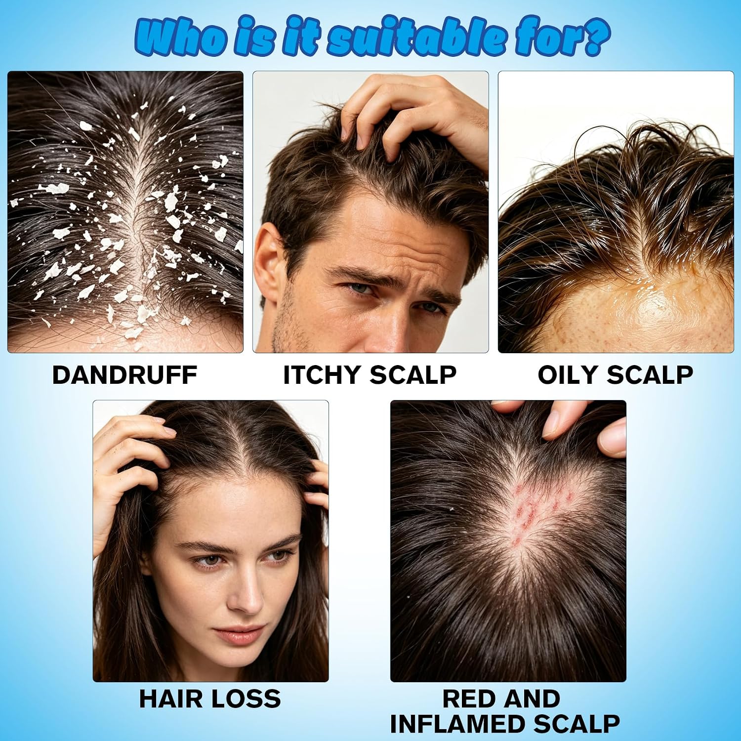Detalle 2 de 1% Ketoconazole Anti-Dandruff Shampoo, 7.78 fl oz for Itchy Scalp