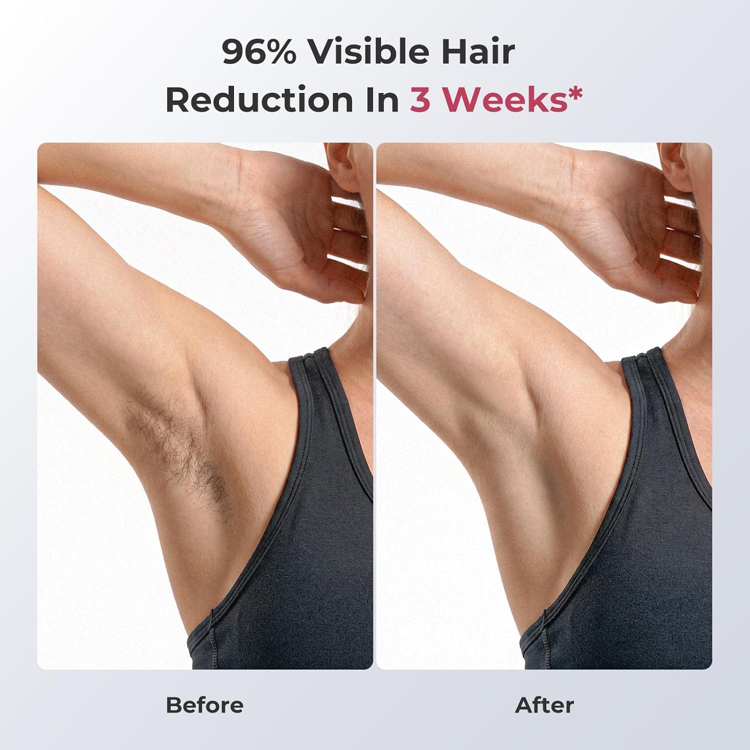 Detalle 2 de Ubroo IPL Hair Removal Device with 45°F Cooling