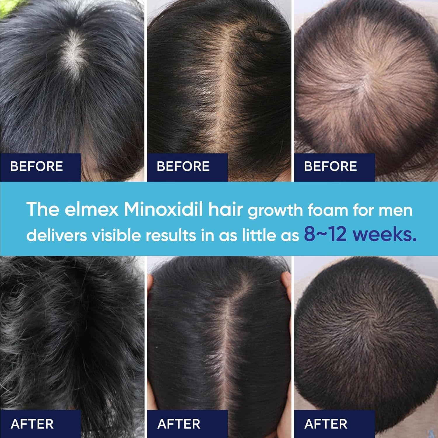 Detalle 2 de 5% Minoxidil Foam for Men and Women with Biotin & Castor Oil – 180ml (3 Packs)