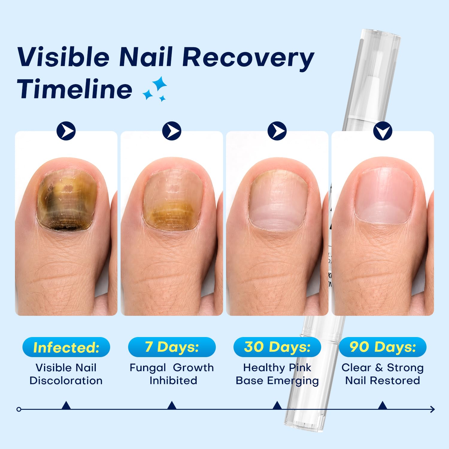 Detalle 1 de Beukow Nail Fungus Treatment Pen with 25% Undecenoic Acid