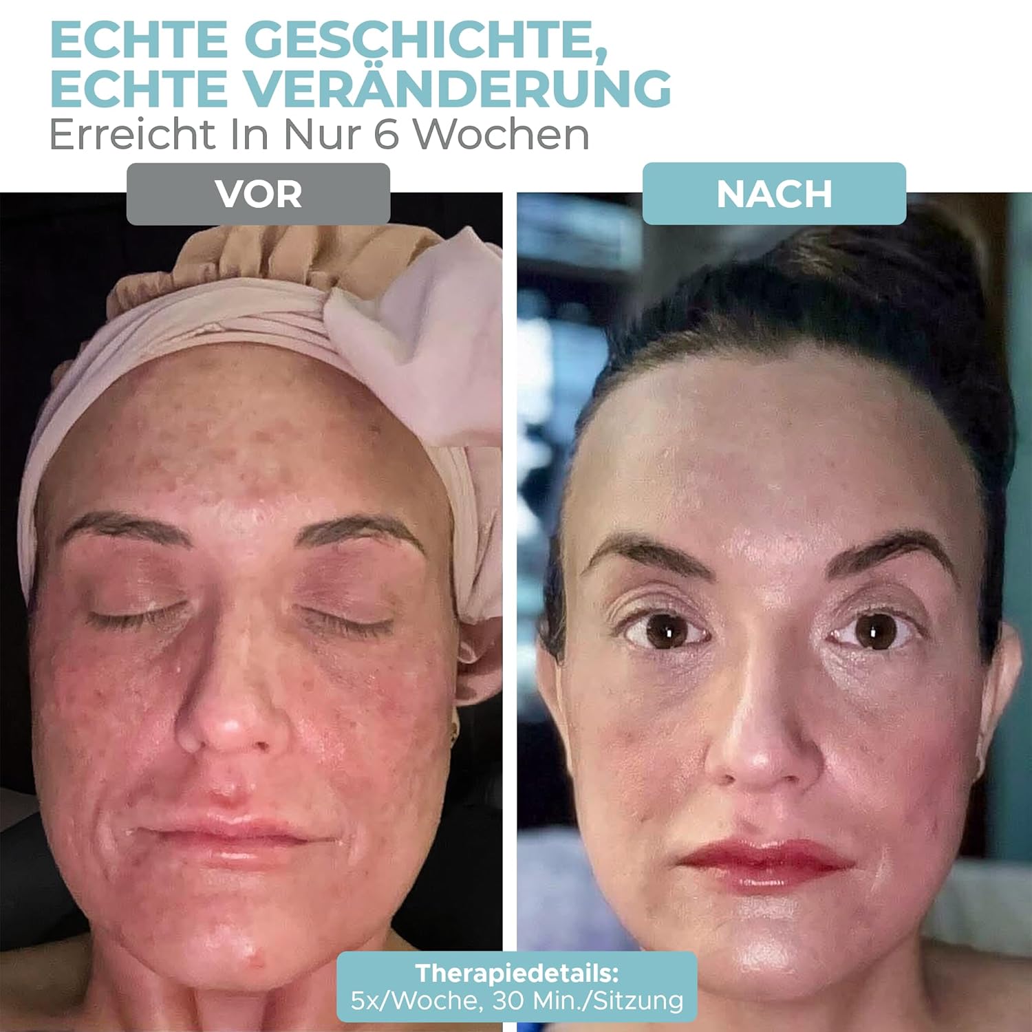 Detalle 2 de Nourished Bodynskin LED Maske 228 LEDs
