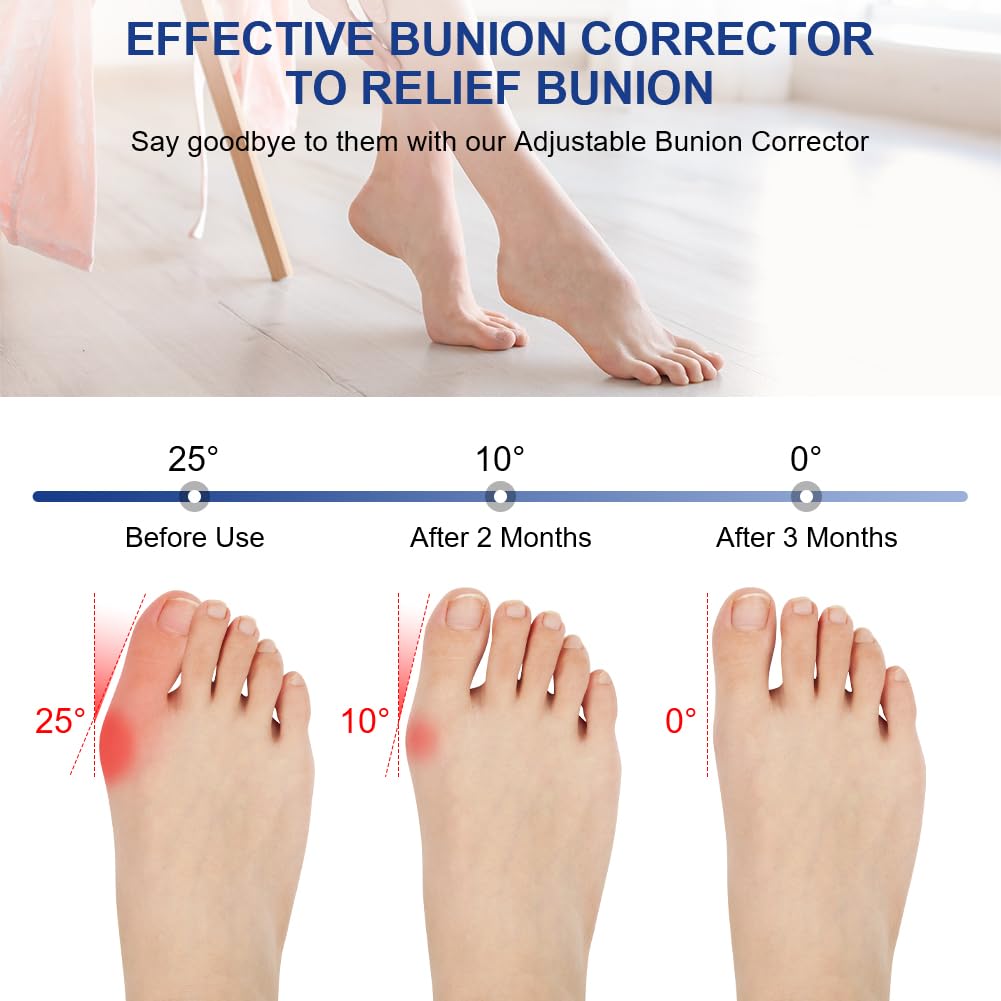 Detalle de ACWOO 4062627 hallux-valgusset met verstelbare spalken en gelteenstrekkers