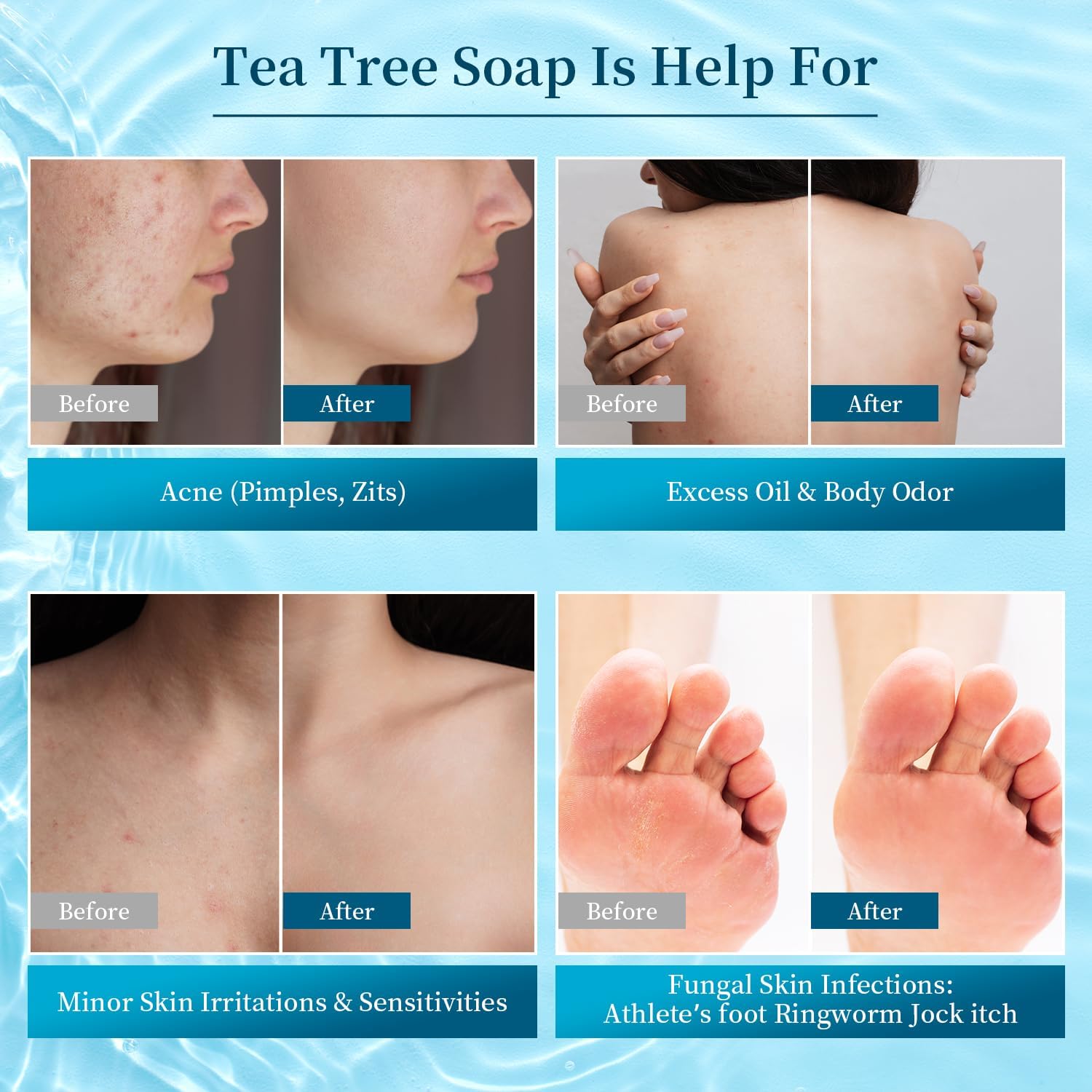 Detalle de YIREG Tea Tree Soap Bar, 3-Pack of 100 g Tea Tree Oil Bars