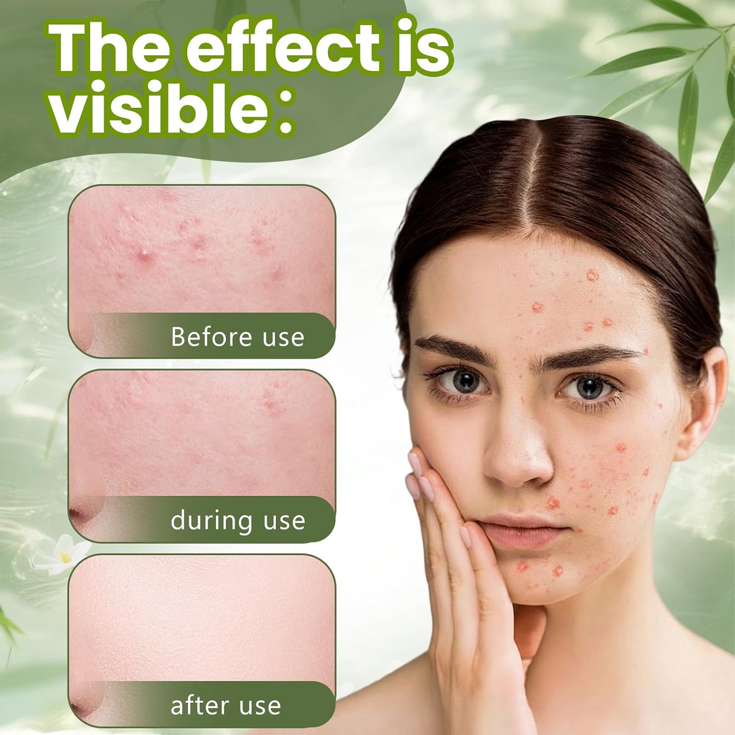 Detalle de TULAMORIY anti-acne gezichtscrème 50 g voor acnegevoelige huid