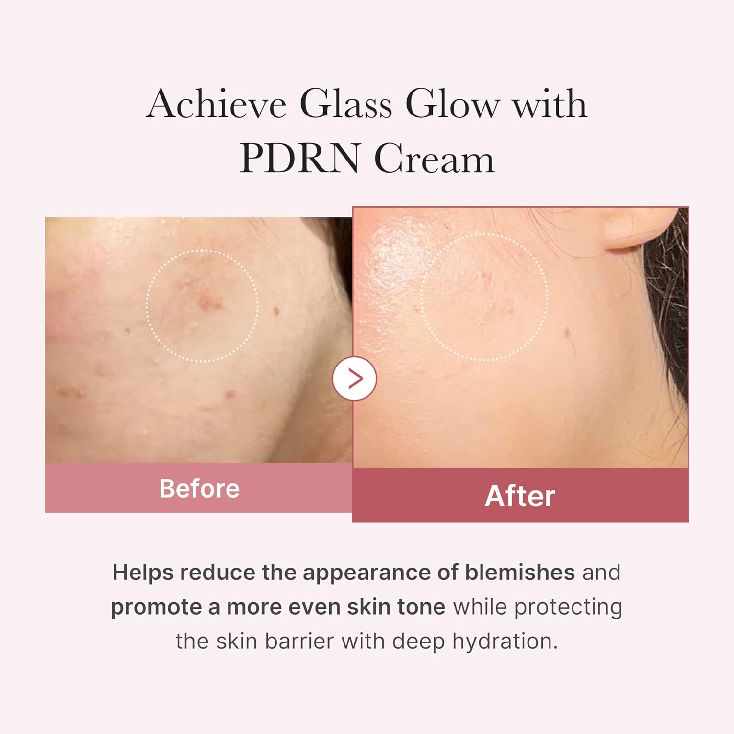 Thumbnail 2 de medicube Salmon Dna Pdrn Pink Hyaluronic Feuchtigkeitscreme für Blemish Relief & Hydration (50 ml)