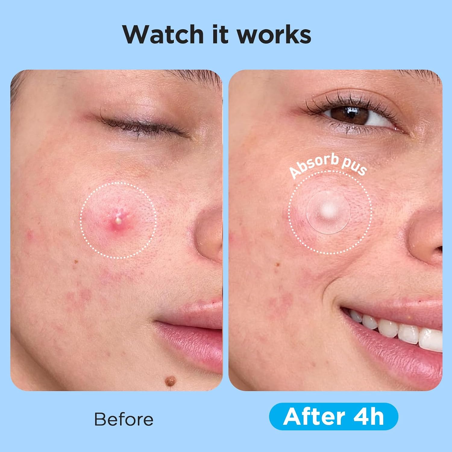 Thumbnail 3 de Glowpatch Pimple Patches 504 Count 🩹