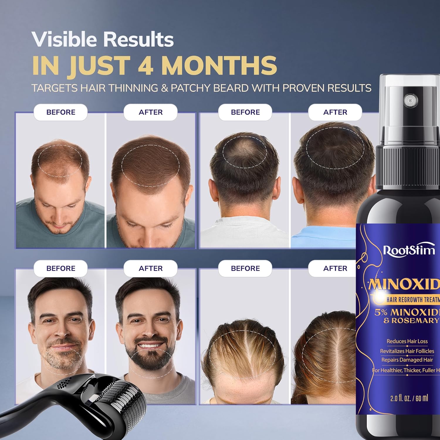 Thumbnail 1 de 5% Minoxidil Kit with 0.25mm Roller ⚙