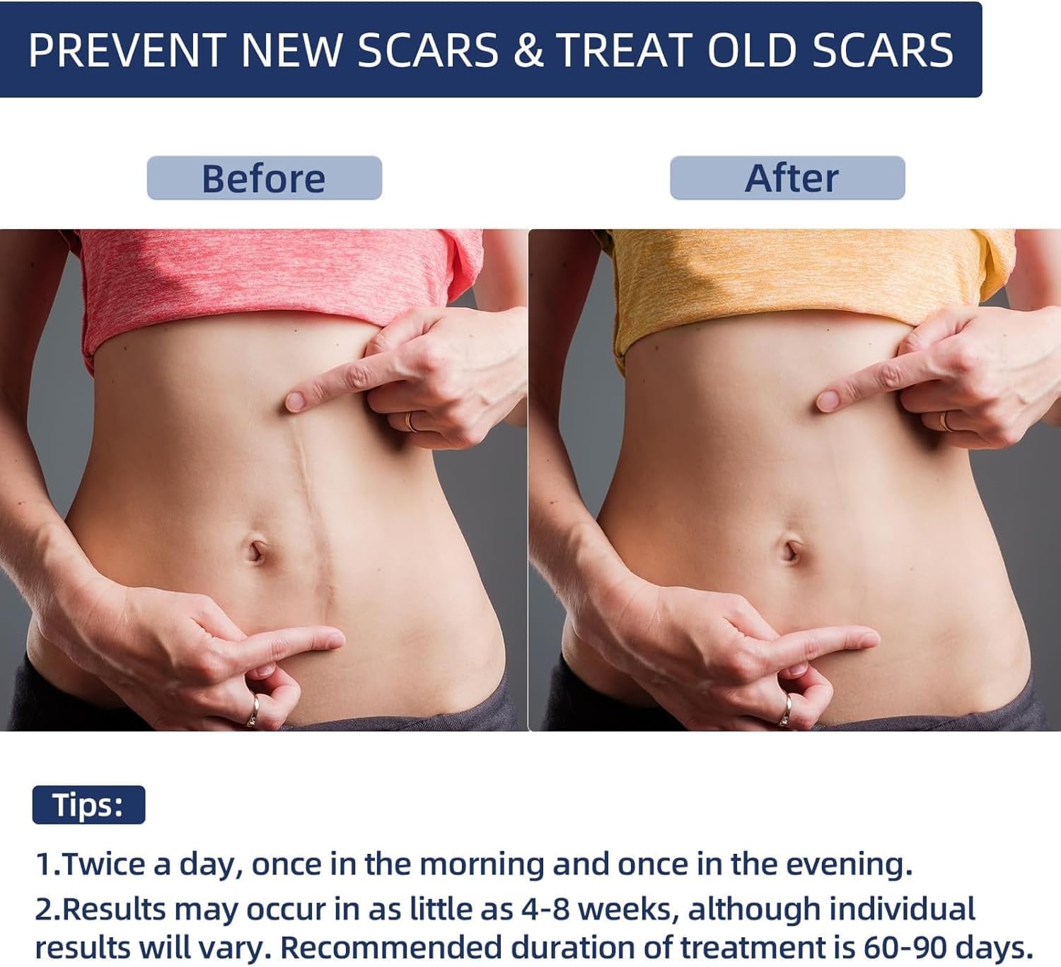Detalle 1 de URAY Silicone Scar Gel, 30 g, 100% Silicone for Old and New Scars