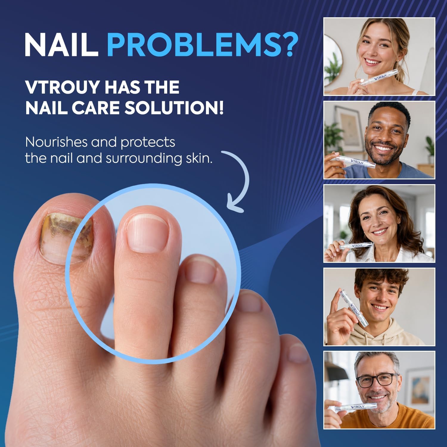 Thumbnail 6 de Toenail fungus treatment pen with 25% undecylenic acid