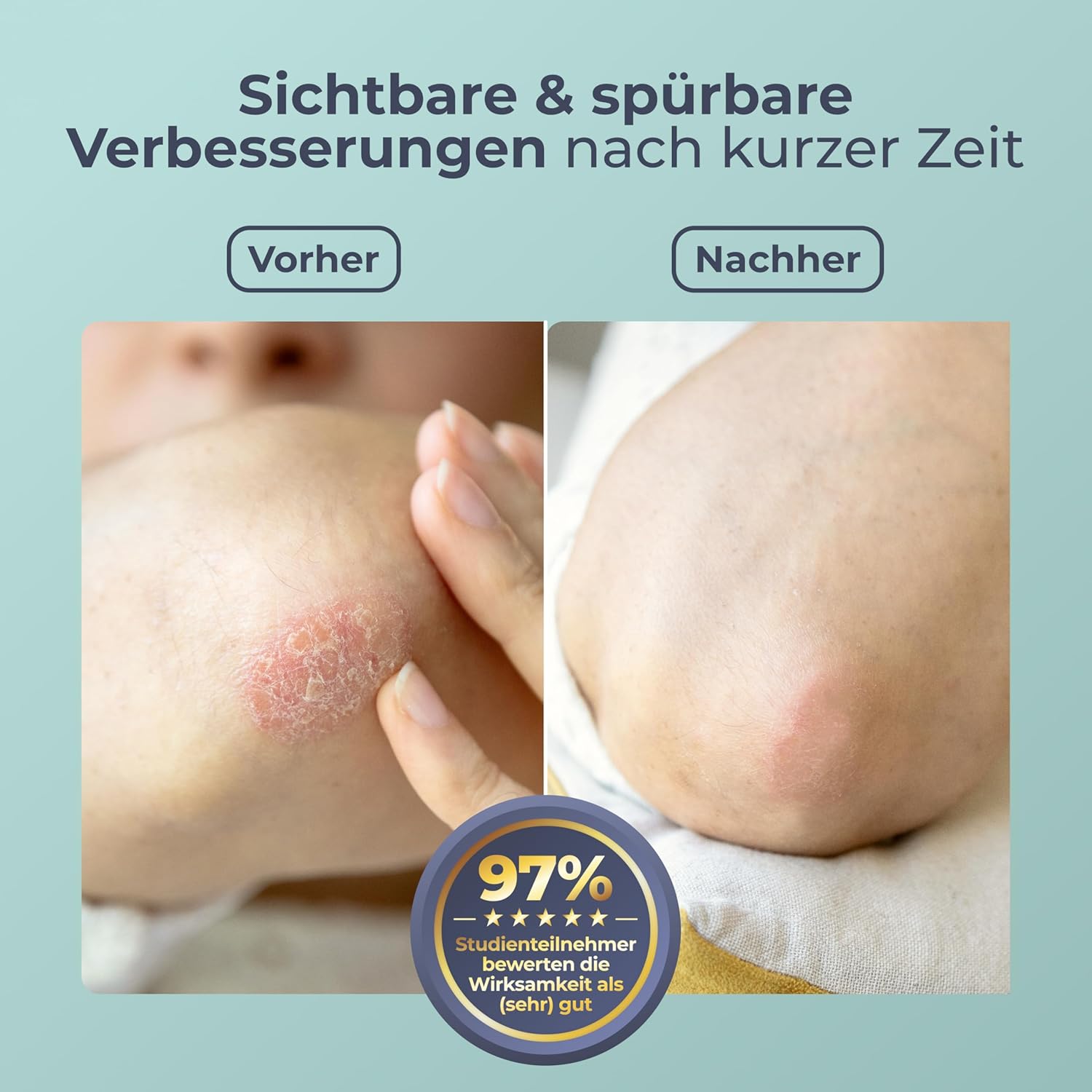 Thumbnail 2 de ectocare® Psoriasis Creme Akut mit 5% Ectoin 30ml – kortisonfrei, dermatologisch geprüft