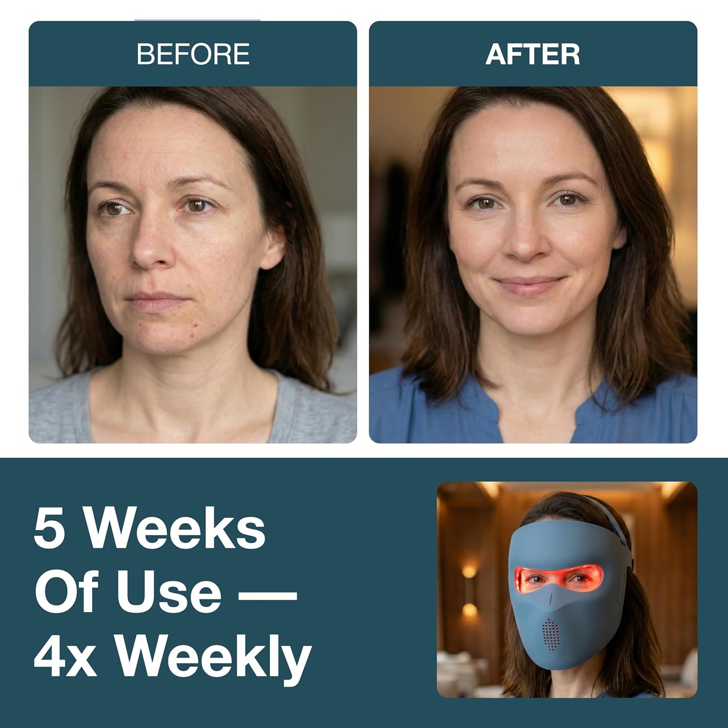 Detalle de Myhalos red light therapy mask