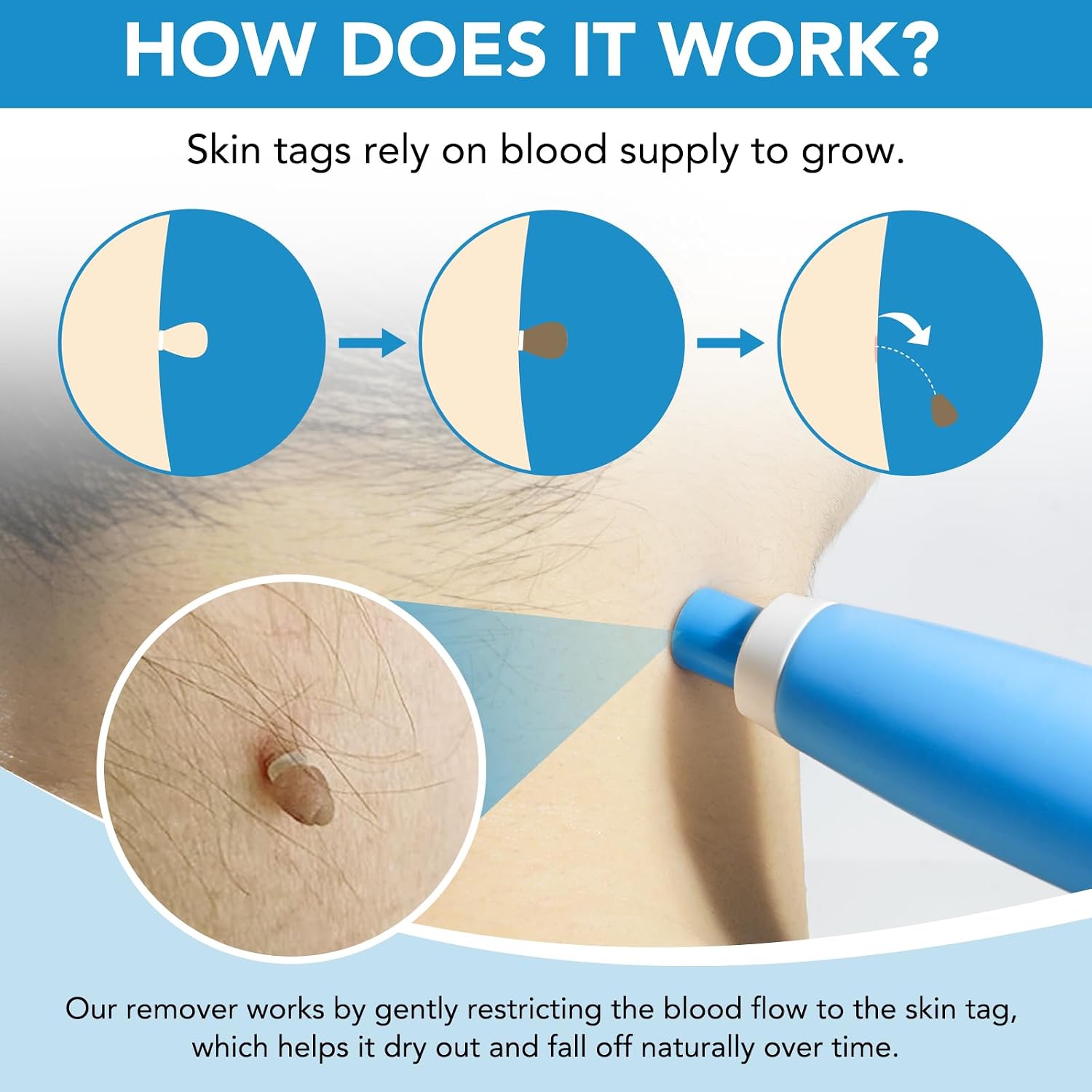 Detalle de Zyloqj Auto Skin Tag Remover Kit zur Selbstentfernung von Hautmarken (2-in-1-Pen, Gummibänder & Reinigungstücher)