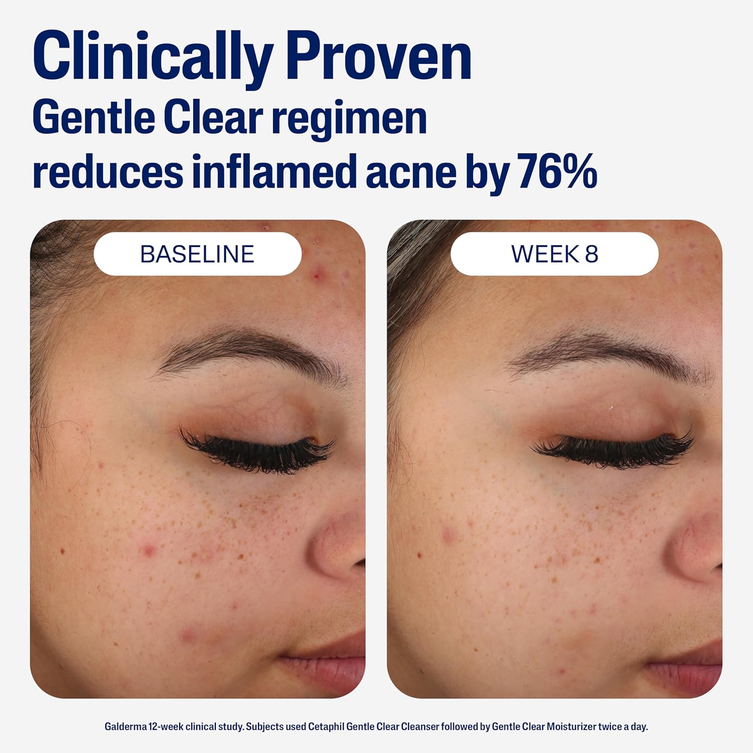 Thumbnail 5 de Cetaphil Face Moisturizer Gentle Clear Mattifying Acne Moisturizer with 0.5% Salicylic Acid (3 oz)