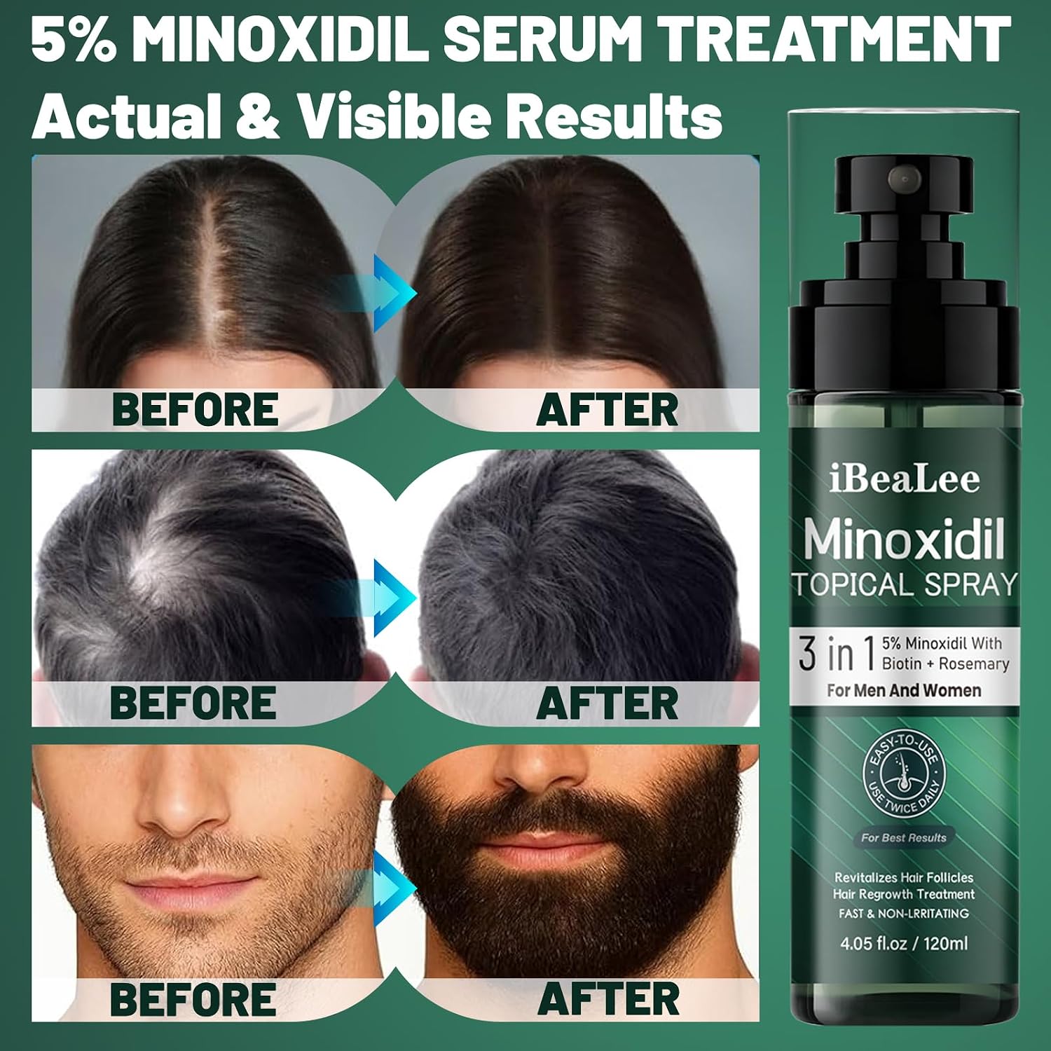 Detalle 1 de OURMUST 5% Minoxidil Hair Regrowth Spray, 2 Bottles with Biotin & Rosemary
