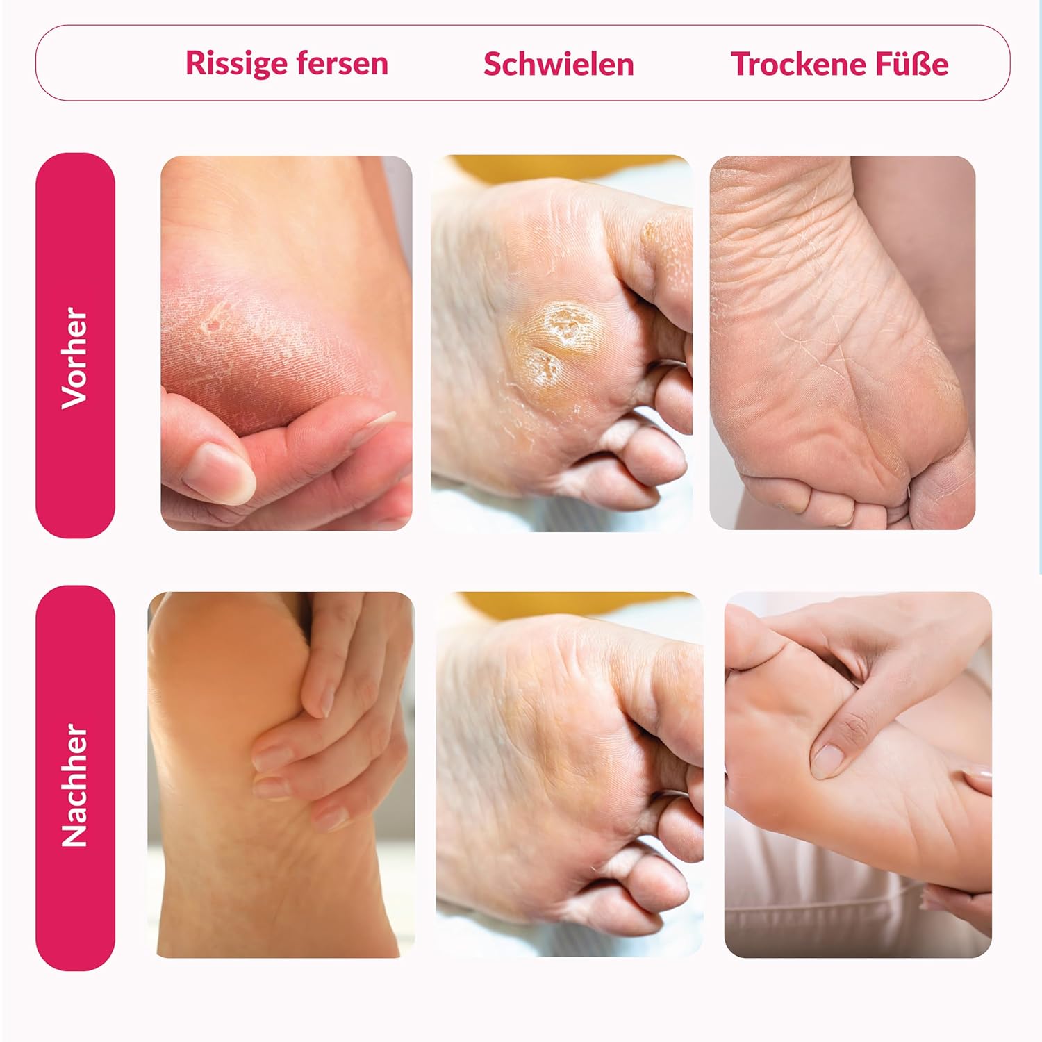 Thumbnail 6 de Summer Foot Premium Hornhaut-Entferner: Fußmaske für samtweiche Füße