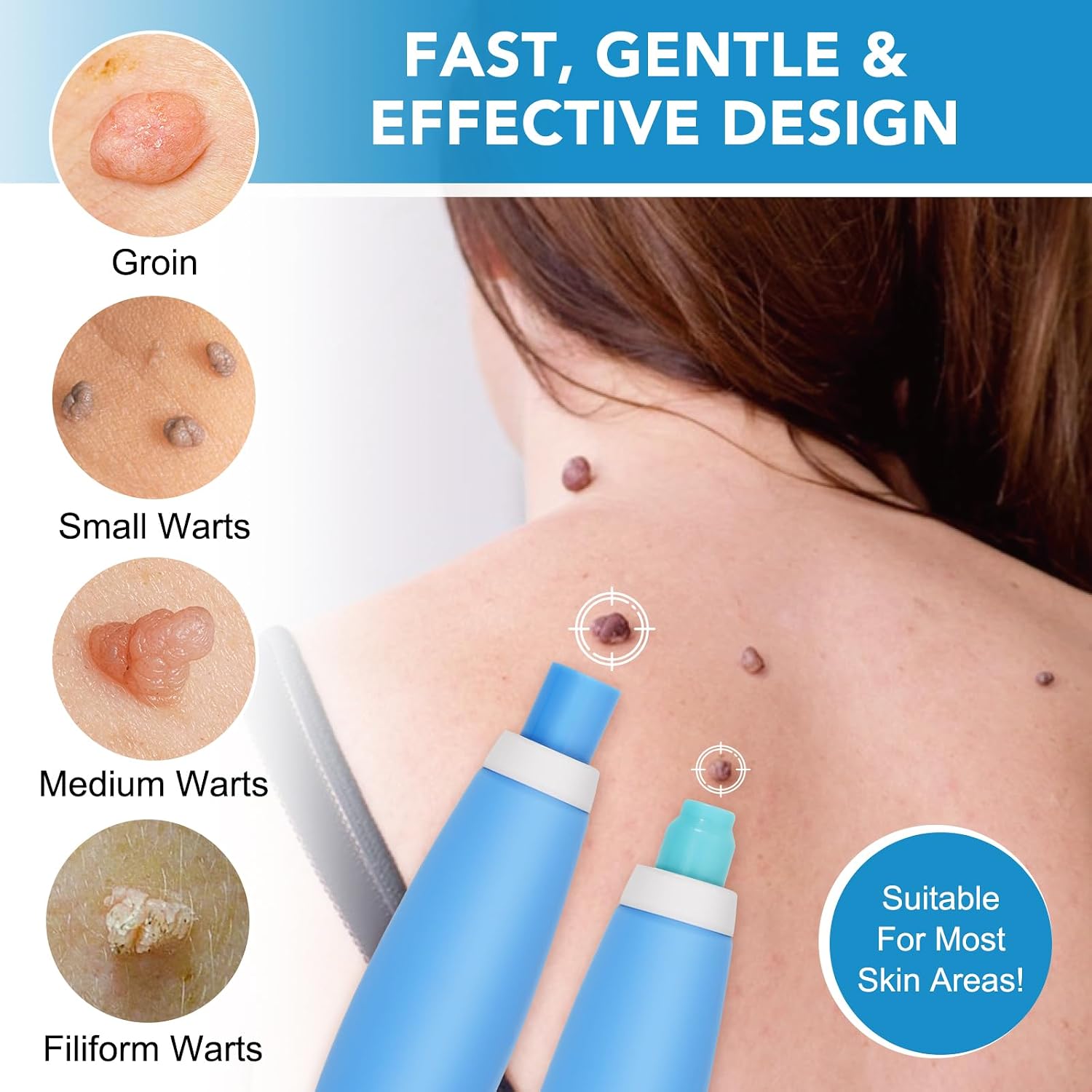 Detalle 2 de Zyloqj Auto Skin Tag Remover Kit zur Selbstentfernung von Hautmarken (2-in-1-Pen, Gummibänder & Reinigungstücher)
