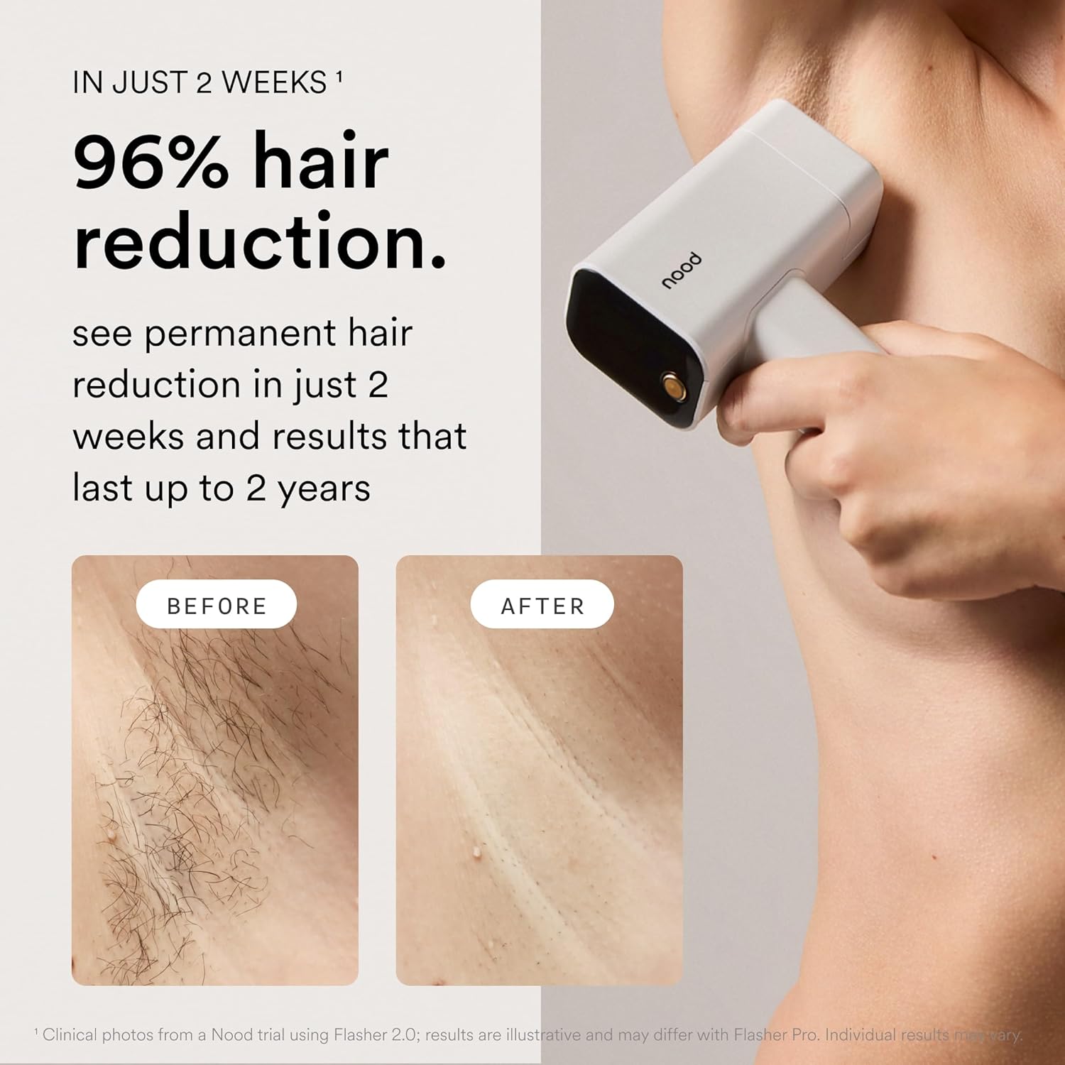 Detalle de Nood NEW Flasher Pro IPL hair removal