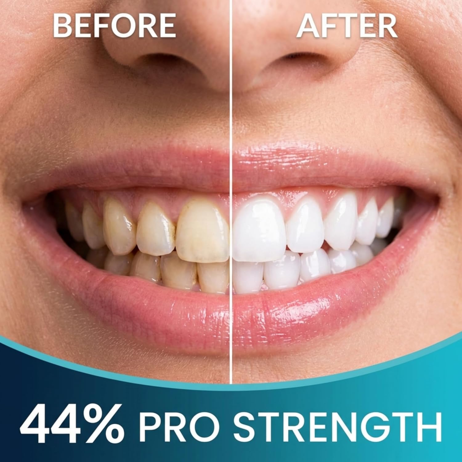 Thumbnail 4 de Pro Strength 44% Carbamide Peroxide Teeth Whitening Gel