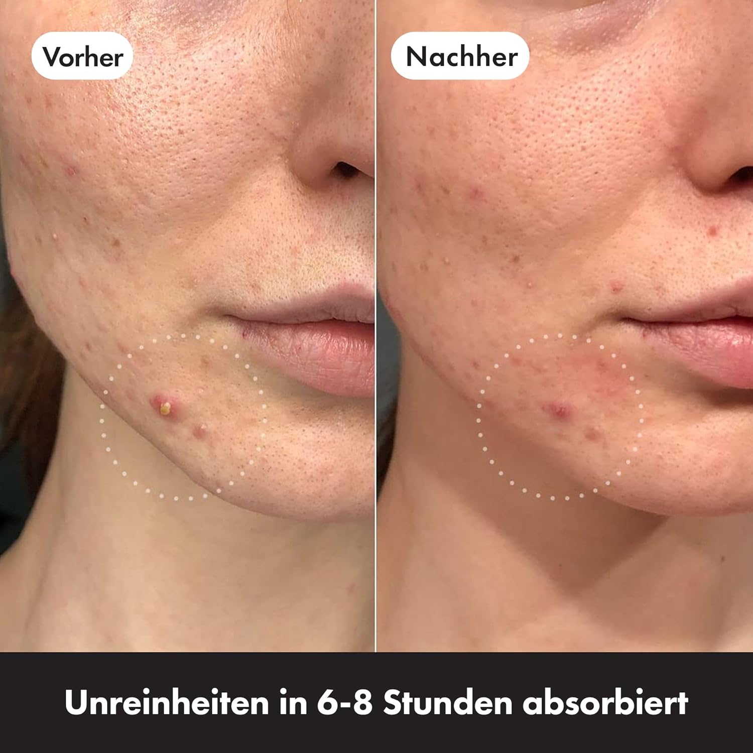 Detalle 2 de Hydrokolloid-Pickelpatch 39 Stück von Hero Cosmetics
