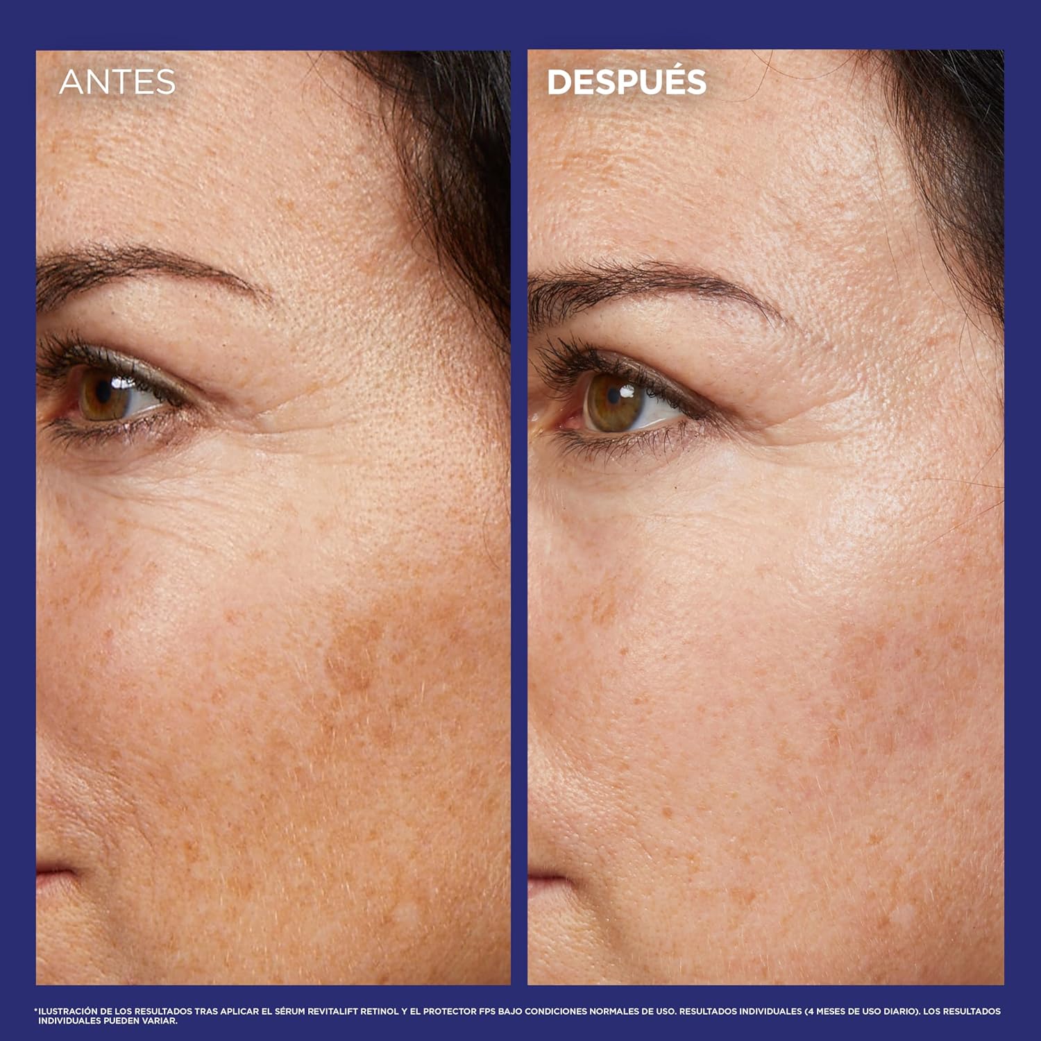 Detalle 2 de L'Oreal Paris Revitalift Laser Retinol 30 ml