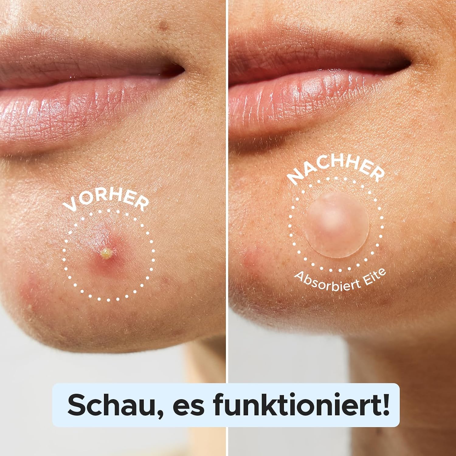Detalle de LitBear Pickel Patch im Großpack – 1008 Stück, 3 Größen (8/10/12 mm) für alle Hauttypen