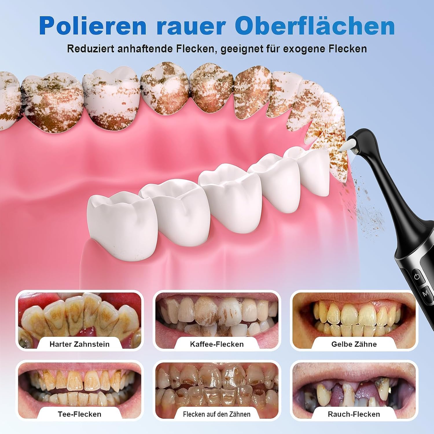 Detalle 2 de Zahnsteinentferner Zahnaufhellungsset Professionell