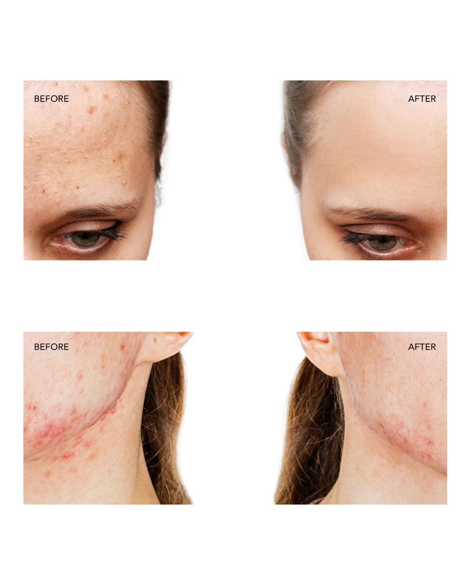 Thumbnail 3 de FOREO ESPADA™ 2 tratamiento acné Cobalt Blue 📷