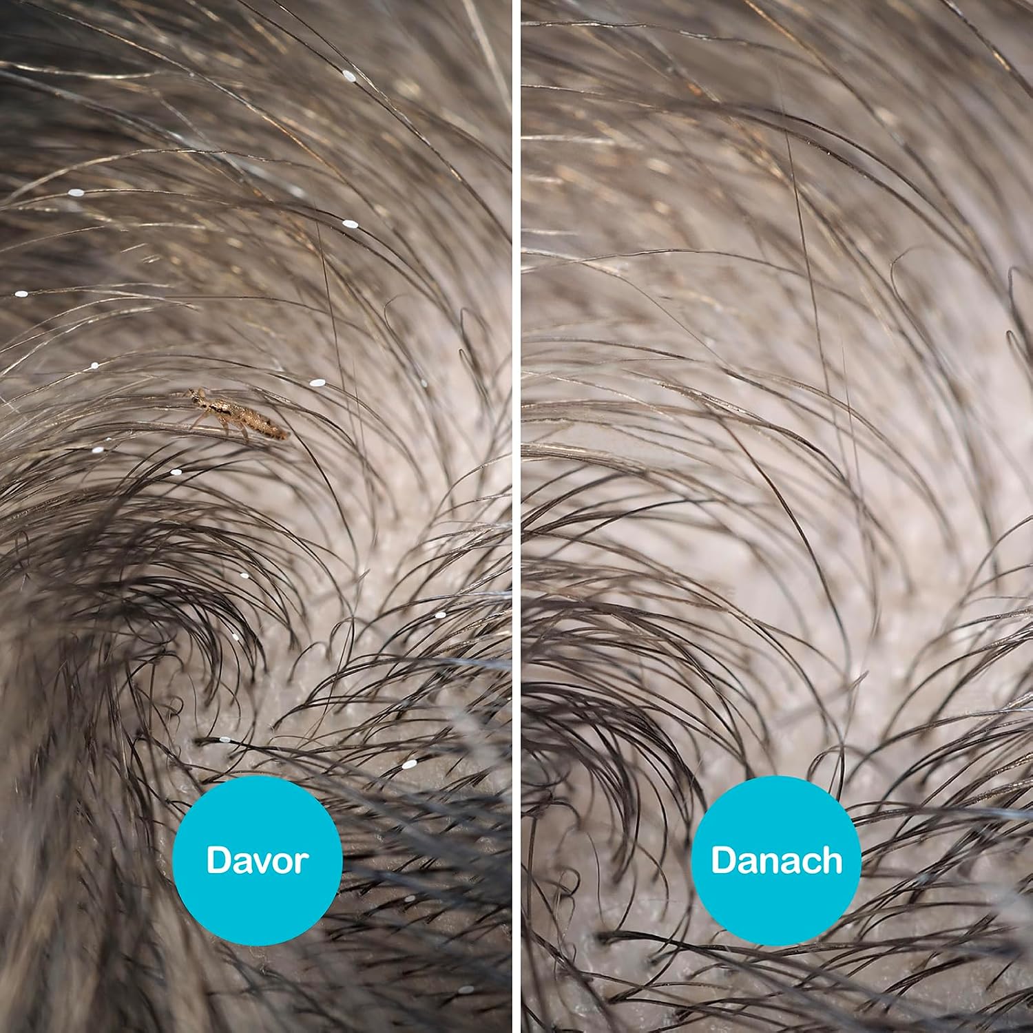 Detalle de NitWits All-In-One Läusespray – 120 ml mit Kamm gegen Kopfläuse (20 Min.)