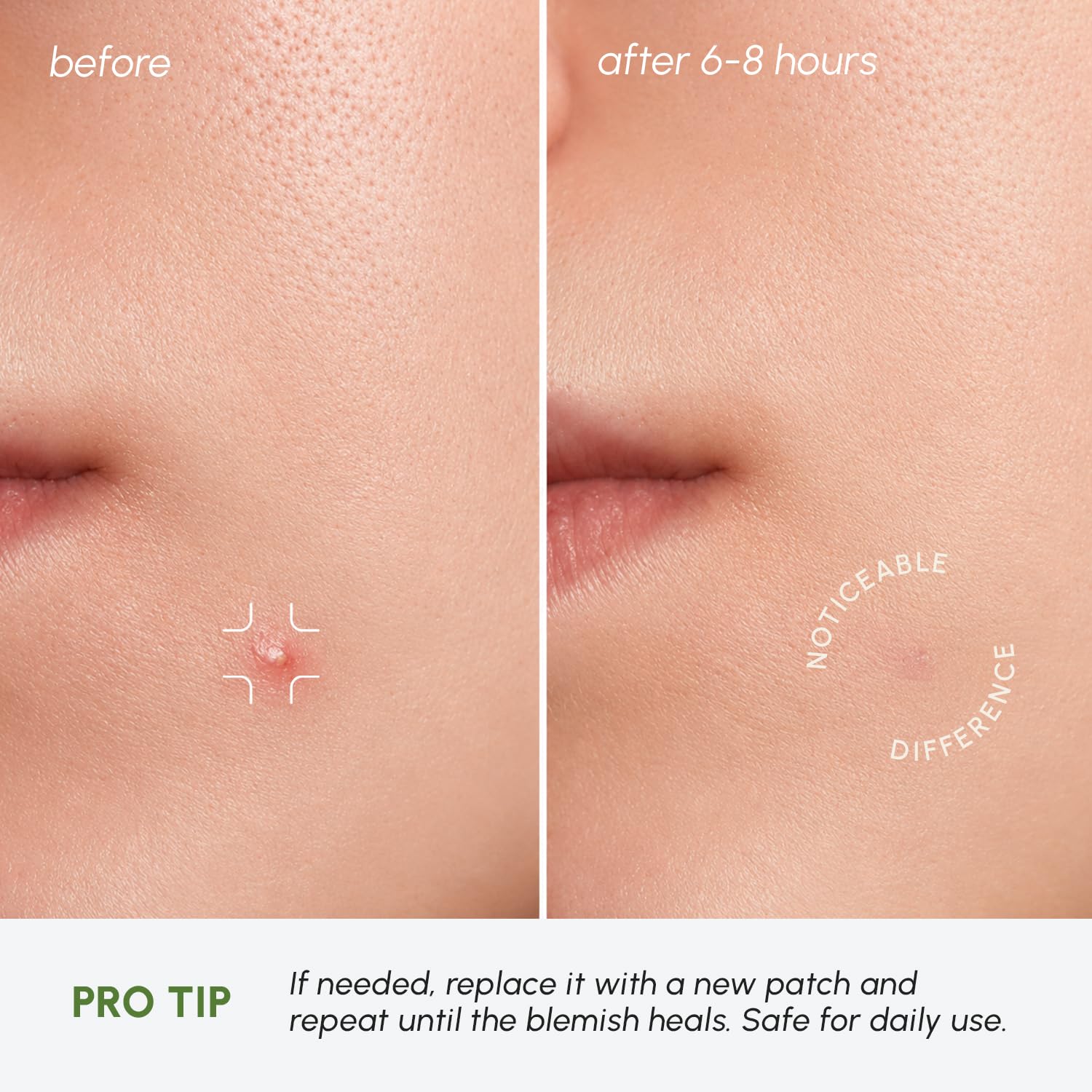 Thumbnail 6 de MAREE Invisible Pimple Patches 72 acne dots